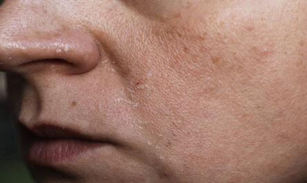 https://media.gettyimages.com/id/2243835395/photo/close-up-of-a-persons-face-showing-dry-flaky-skin-and-rich-texture.jpg?s=612x612&w=0&k=20&c=S20Us5boem-Dxkcu5qRZBDKO42xyPEyTPnk0h7yBif8=
