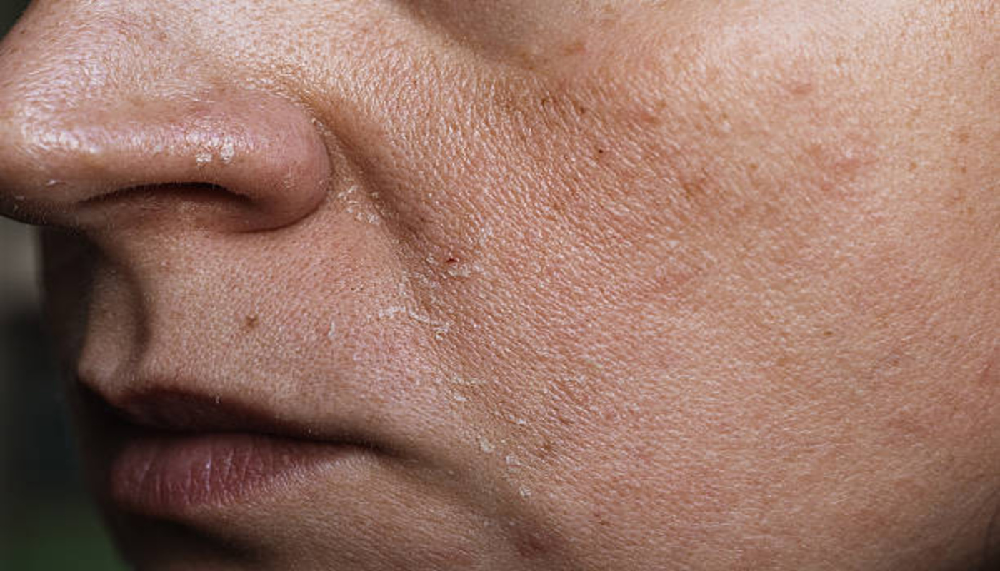 https://media.gettyimages.com/id/2243835395/photo/close-up-of-a-persons-face-showing-dry-flaky-skin-and-rich-texture.jpg?s=612x612&w=0&k=20&c=S20Us5boem-Dxkcu5qRZBDKO42xyPEyTPnk0h7yBif8=