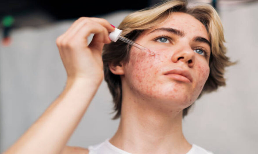Why Acne Representation Is Growing in Advertising