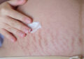 https://media.gettyimages.com/id/1208097877/photo/pregnant-woman-applying-moisturizer-on-stretch-marks.jpg?s=612x612&w=0&k=20&c=2hZdfNgyLkvsiOF5CyhstWwVikidjQ21qQ82MTx_958=