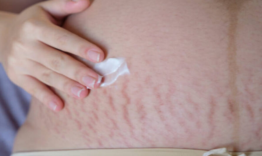 The Cultural Importance of Seeing Stretch Marks in Advertising
