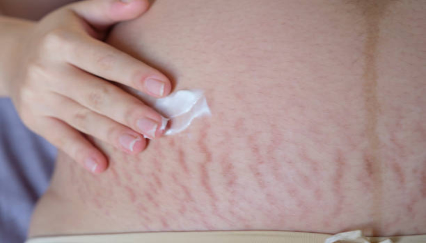 https://media.gettyimages.com/id/1208097877/photo/pregnant-woman-applying-moisturizer-on-stretch-marks.jpg?s=612x612&w=0&k=20&c=2hZdfNgyLkvsiOF5CyhstWwVikidjQ21qQ82MTx_958=