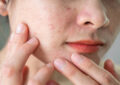 https://media.gettyimages.com/id/1469751146/photo/cropped-shot-of-asian-woman-having-wrinkled-and-acne-scar-occur-on-her-face.jpg?s=612x612&w=0&k=20&c=X6k4FPHR-ctv6cMFyMkF113Po9MeMYgLjETLJT_UX1E=