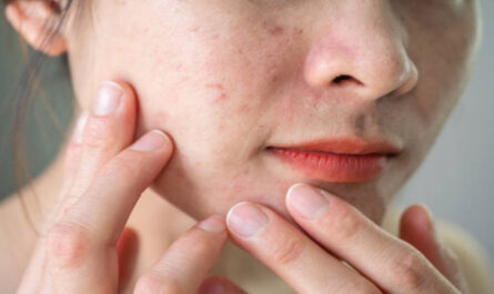 https://media.gettyimages.com/id/1469751146/photo/cropped-shot-of-asian-woman-having-wrinkled-and-acne-scar-occur-on-her-face.jpg?s=612x612&w=0&k=20&c=X6k4FPHR-ctv6cMFyMkF113Po9MeMYgLjETLJT_UX1E=