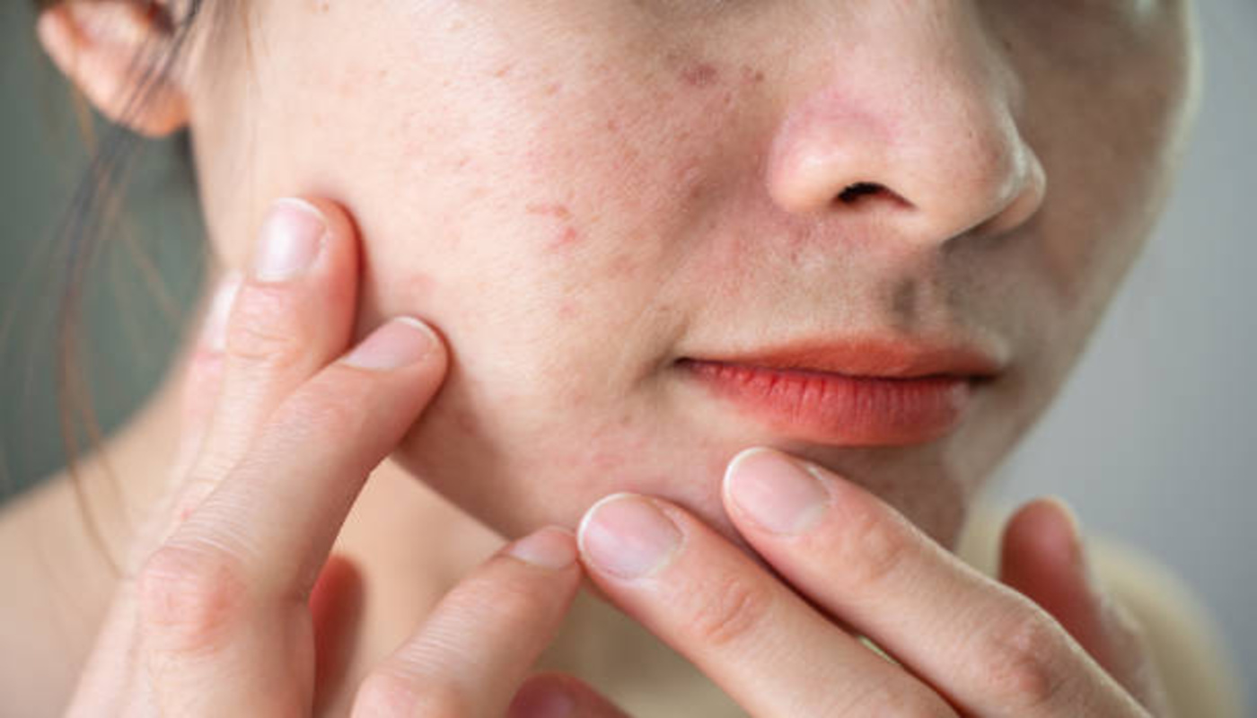 https://media.gettyimages.com/id/1469751146/photo/cropped-shot-of-asian-woman-having-wrinkled-and-acne-scar-occur-on-her-face.jpg?s=612x612&w=0&k=20&c=X6k4FPHR-ctv6cMFyMkF113Po9MeMYgLjETLJT_UX1E=